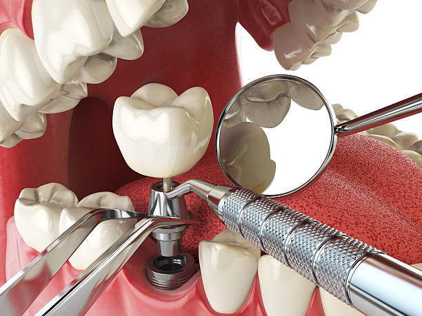 Best Emergency Wisdom Teeth Removal in Chamberlain, SD